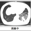 隨州市中心醫(yī)院：【特色技術(shù)】微創(chuàng)技術(shù)新突破，冷凍消融治療精準(zhǔn)“凍殺”癌細(xì)胞
