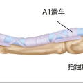 隨州市中心醫(yī)院【特色技術(shù)】超聲引導(dǎo)小針刀松解術(shù) 告別“扳機指”困擾