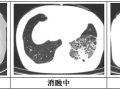 隨州市中心醫(yī)院：【特色技術(shù)】微創(chuàng)技術(shù)新突破，冷凍消融治療精準“凍殺”癌細胞